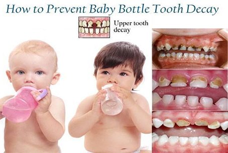 Baby Bottle Tooth Decay Treatment