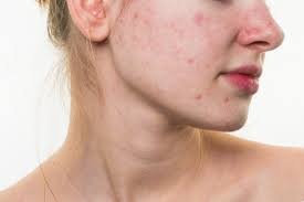 Best Tips For Acne Scars