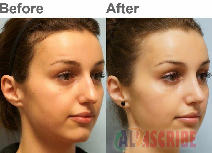 Rhinoplasty And Cosmetic Surgery effect