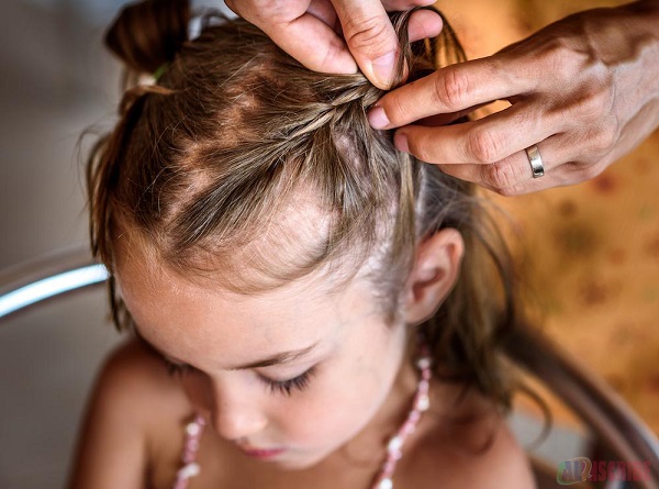  Hair loss in Kids