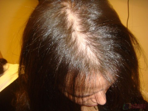 Androgenic Alopecia