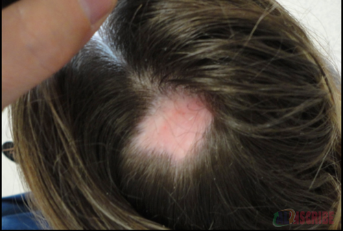  Alopecia areata