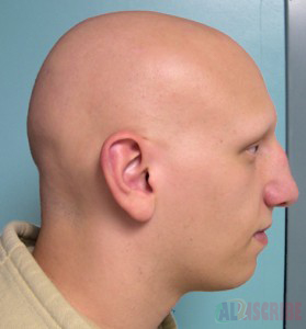 Alopecia Universalis (AU)