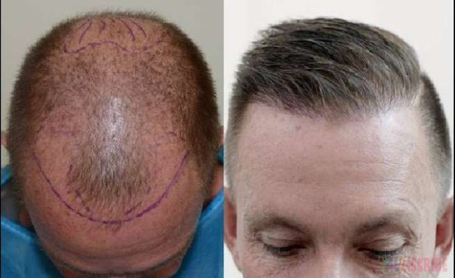 Hair Transplant- before and after