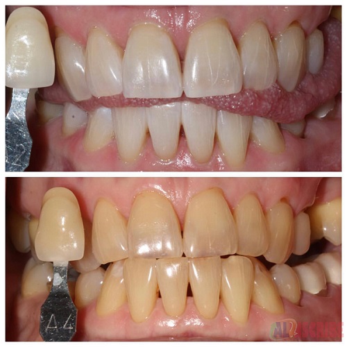 In-Office Teeth Whitening