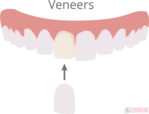 Veneers