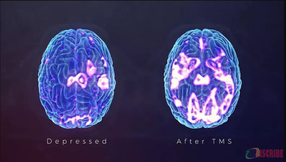 Before and after TMS